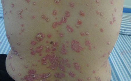 銀屑病病因,冬季銀屑病病因,濰坊銀屑病醫院的治療方式