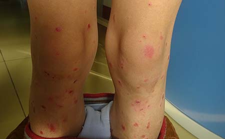 濰坊牛皮癬哪個(gè)醫(yī)院治療好牛皮癬能治好嗎