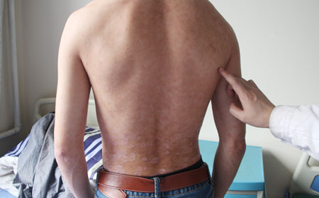 銀屑病的治療方法都有什么