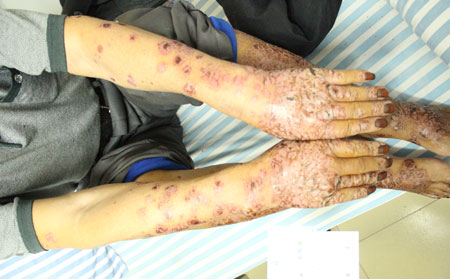 銀屑病是好治的