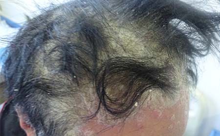 濰坊銀康醫(yī)院,尋常型銀屑病圖片