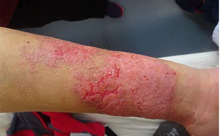 兒童銀屑病圖片,兒童尋常型銀屑病圖片