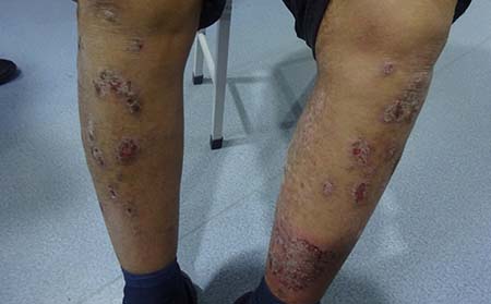 腿部銀屑病圖片,腿部銀屑病癥狀