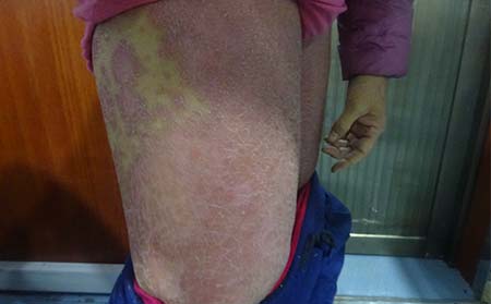 身上牛皮癬癥狀,身上牛皮癬癥狀圖片