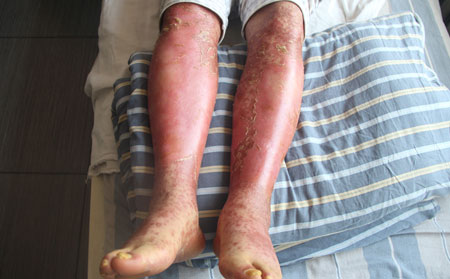 腳上銀屑病癥狀,腳上銀屑病圖片