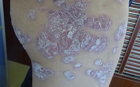 地圖狀銀屑病癥狀,地圖狀銀屑病癥狀圖片