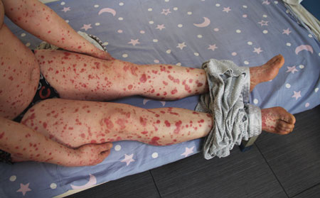 關節型牛皮癬癥狀.關節型牛皮癬癥狀圖片