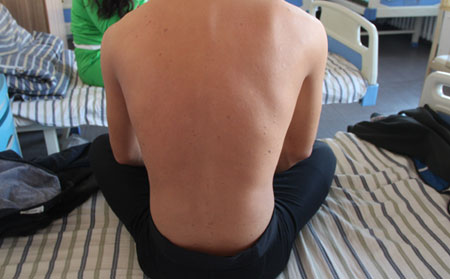 尋常型牛皮癬圖片,尋常型牛皮癬癥狀圖片