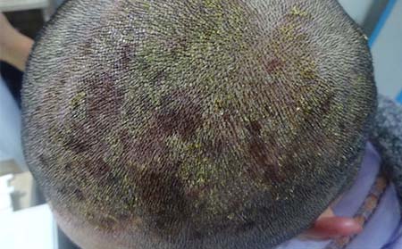 頭部銀屑病防治,怎樣防治頭部銀屑病