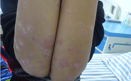 如何預防兒童銀屑病,防治兒童銀屑病方法