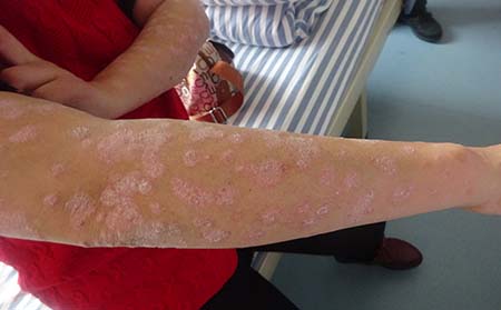 牛皮癬治療,怎樣去治牛皮癬好