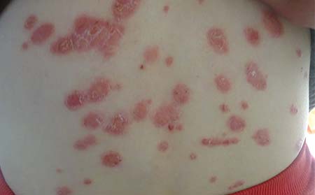 尋常型銀屑病癥狀,尋常型銀屑病圖片