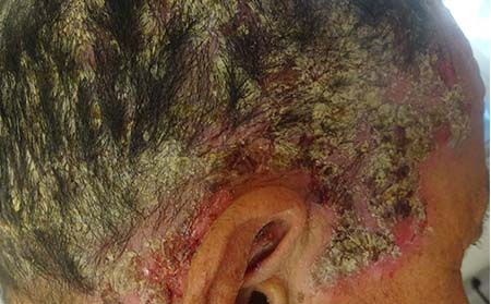 膿皰型牛皮癬圖片,膿皰型牛皮癬癥狀