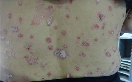 銀屑病癥狀,背部銀屑病癥狀