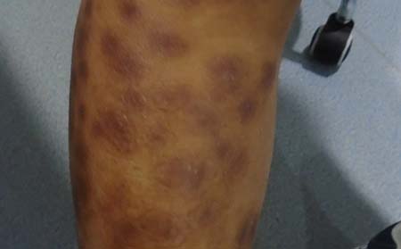 腿部牛皮癬癥狀,腿部牛皮癬癥狀圖片