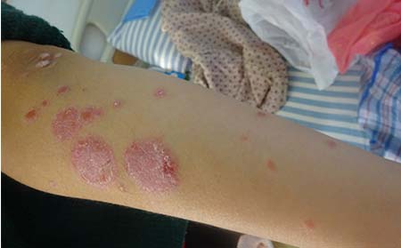 小孩牛皮癬癥狀,小孩牛皮癬早期牛皮癬癥狀