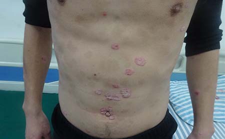 男性銀屑病癥狀,男性銀屑病癥狀圖片