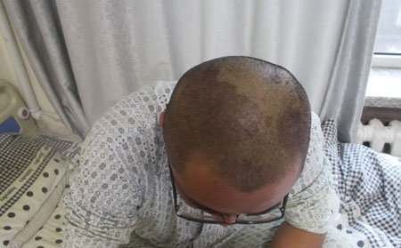 頭部銀屑病癥狀,頭部銀屑病癥狀圖片