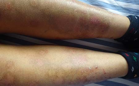 牛皮癬初期圖片,牛皮癬初期癥狀表現