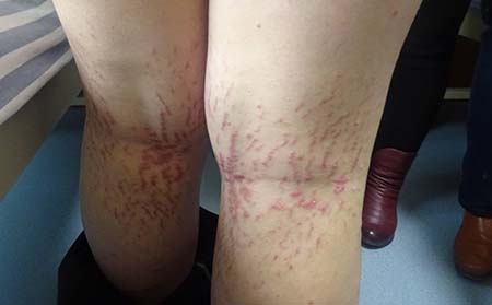 尋常型銀屑病癥狀,尋常型銀屑病典型癥狀