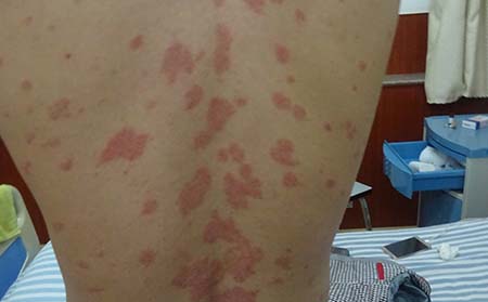 背部牛皮癬癥狀,背部牛皮癬癥狀圖片