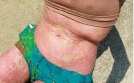 兒童牛皮癬預(yù)防,怎樣預(yù)防兒童牛皮癬