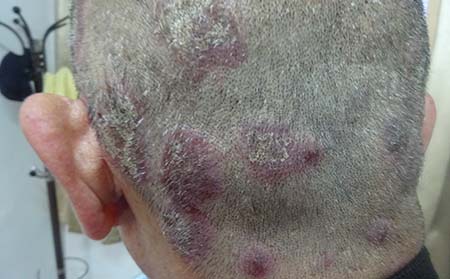 頭部牛皮癬治療,怎樣治頭部牛皮癬