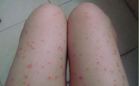 女性牛皮癬癥狀,女性牛皮癬癥狀圖片