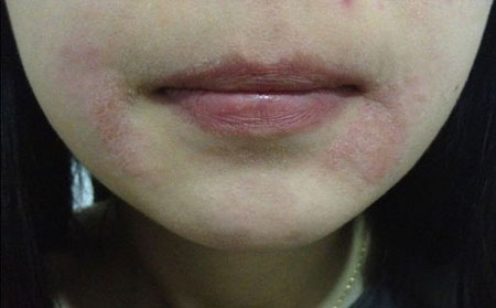 女性銀屑病預防,女性如何預防銀屑病