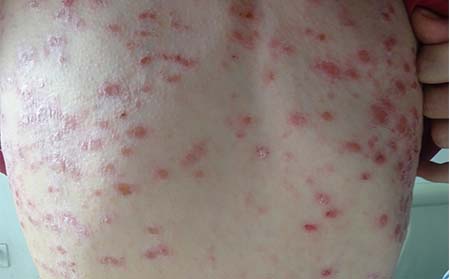 常型牛皮癬癥狀表現(xiàn),尋常型牛皮癬特征