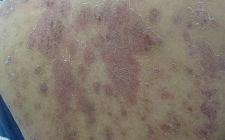 男性牛皮癬癥狀,男性患牛皮癬癥狀表現