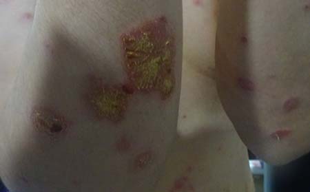 銀屑病發病原因,銀屑病病因