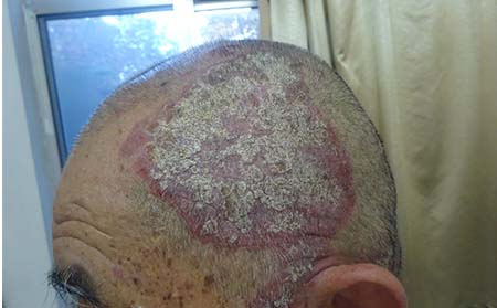 老年銀屑病常識,老年銀屑病特點