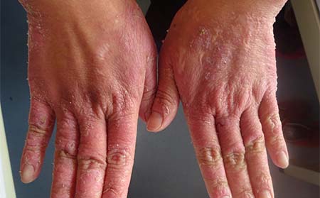 關節型銀屑病癥狀,怎樣診斷關節型銀屑病