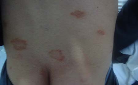 牛皮癬癥狀,牛皮癬早期癥狀