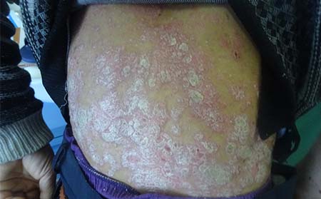 牛皮癬常識,牛皮癬常識了解