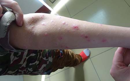 牛皮癬危害,牛皮癬器官危害