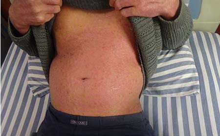 如何防治牛皮癬,怎樣防治牛皮癬好