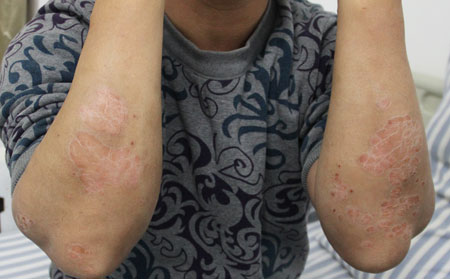 濰坊治牛皮癬醫院電話,濰坊看牛皮癬醫院電話