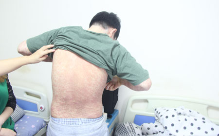 得銀屑病病因,為什么身上長銀屑病