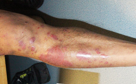 有銀屑病注意什么,身上長銀屑病注意