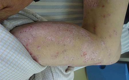 銀屑病癥狀,銀屑病常見癥狀