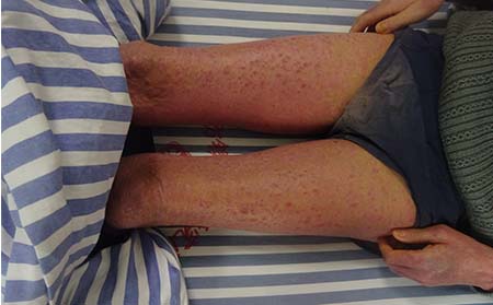 銀屑病治療,輕微銀屑病治療