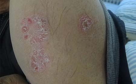 日常防治牛皮癬方法,怎樣防治牛皮癬