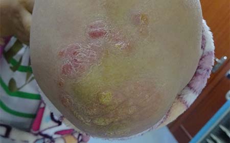 初期牛皮癬癥狀,牛皮癬初期癥狀表現