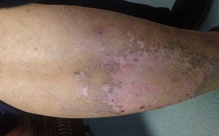 銀屑病防治注意,銀屑病防治注意事項