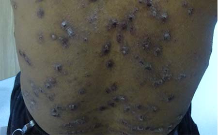 膿皰型銀屑病癥狀,怎樣診斷膿皰型銀屑病