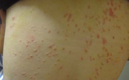 兒童牛皮癬癥狀,兒童牛皮癬初期癥狀