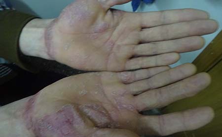 銀屑病擴散預防,怎樣預防銀屑病擴散