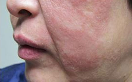 女性臉部牛皮癬前期的癥狀表現(xiàn)
